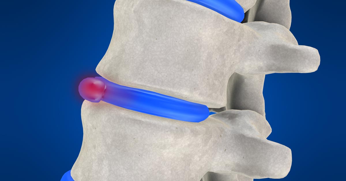 Waldorf, MD non-surgical disc herniation treatment