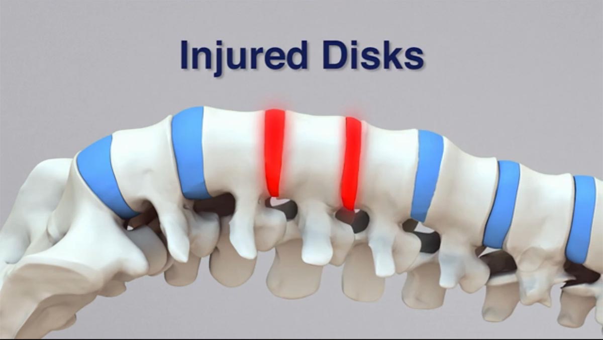 Waldorf, MD non-surgical spinal decompression