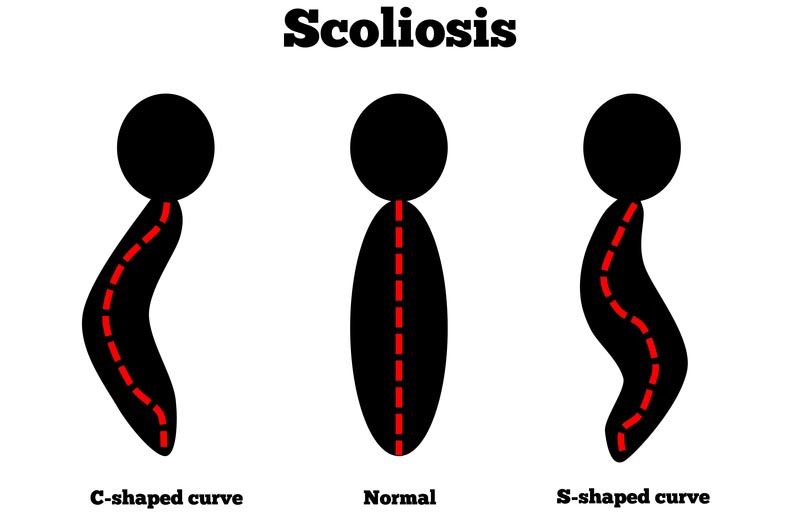 Waldorf, MD scoliosis treatment